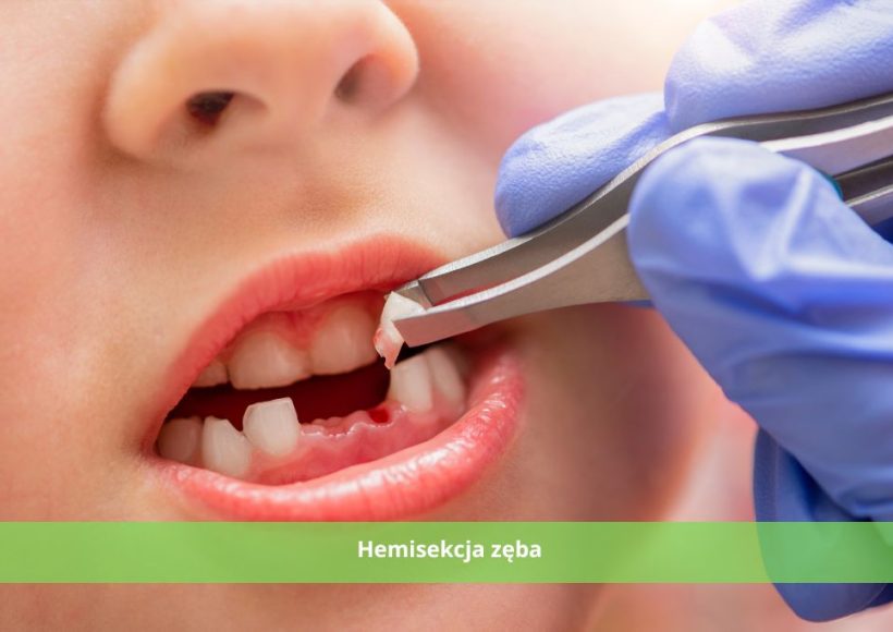 hemisekcja zęba