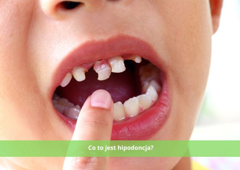 Co to jest hipodoncja? Objawy, przyczyny i leczenie