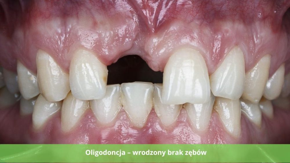 Oligodoncja czym jest ta choroba