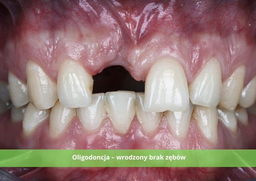 Oligodoncja czym jest ta choroba