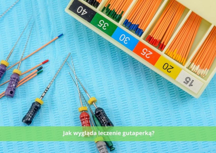 Jak wygląda leczenie gutaperką? Gutaperka w kanale.
