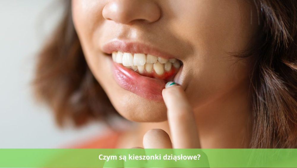 Czym są kieszonki dziąsłowe i czy wymagają leczenia?