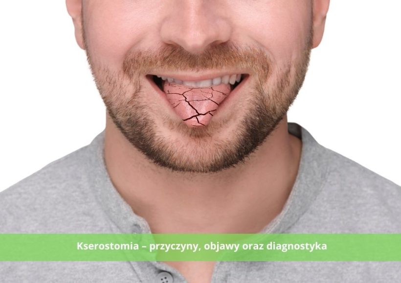 Kserostomia – jakie są przyczyny