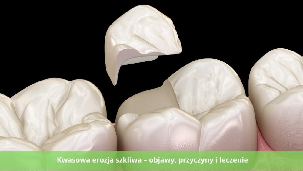 Kwasowa erozja szkliwa – objawy, przyczyny i leczenie