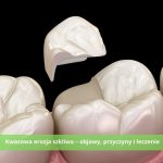 Kwasowa erozja szkliwa – objawy, przyczyny i leczenie