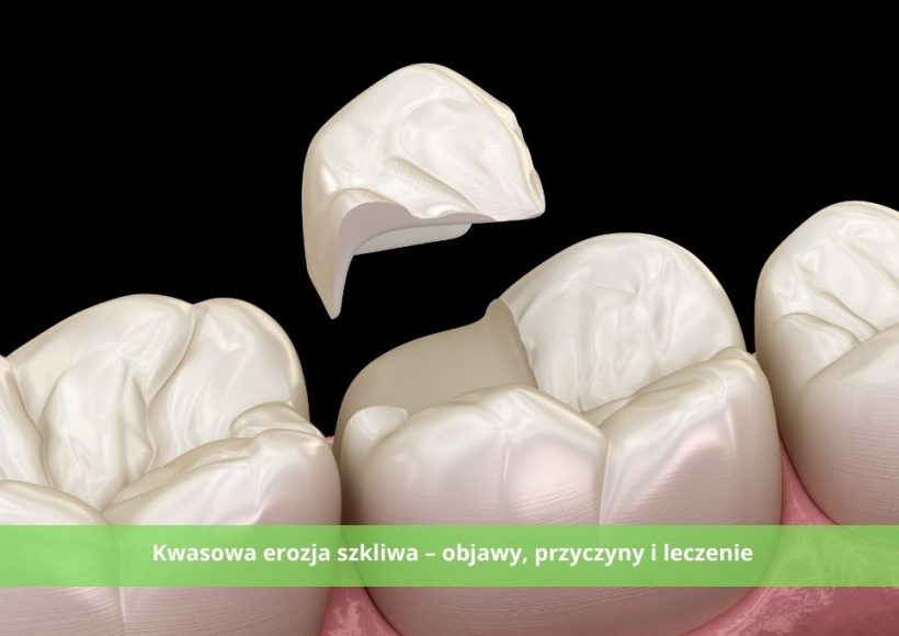 Kwasowa erozja szkliwa – objawy, przyczyny i leczenie
