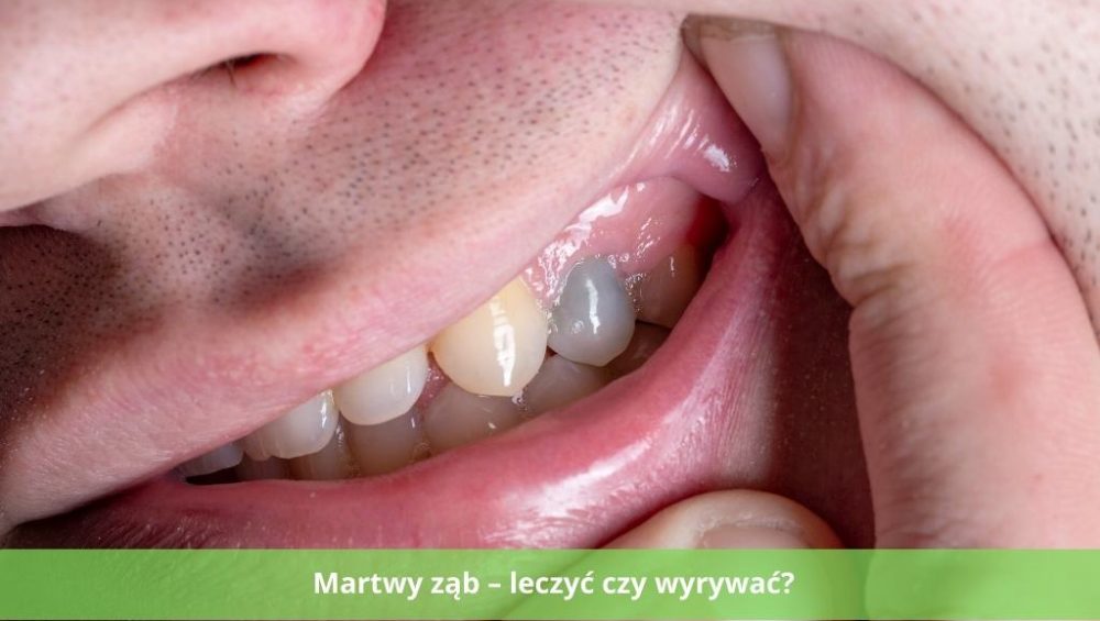 martwy ząb