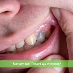 martwy ząb