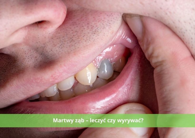 martwy ząb