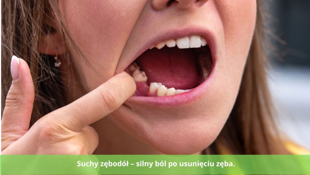 Suchy zębodół – silny ból po usunięciu zęba. Jak go rozpoznać i wyleczyć?