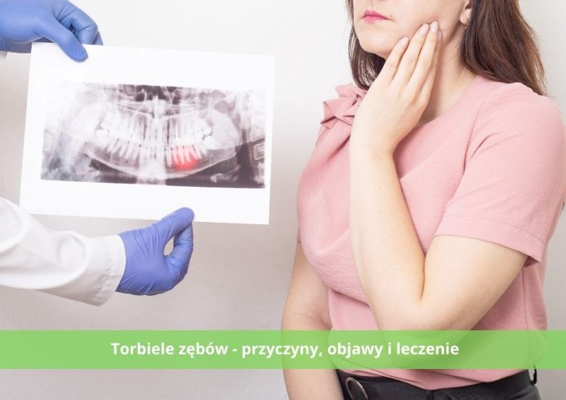 Torbiele zębów - przyczyny, objawy i leczenie