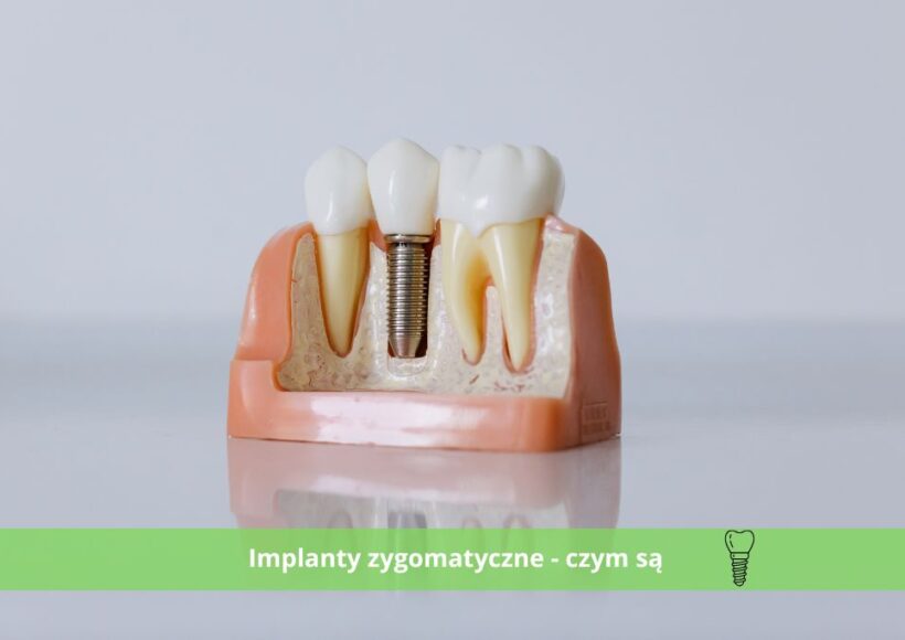 implanty zygomatyczne