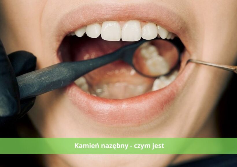 kamień nazębny