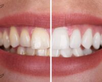 wybielenie zębów w vital dent