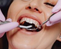 fleczer dentystyczny